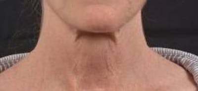 Necklift Before & After Gallery - Patient 164755 - Image 1