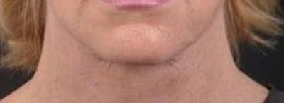 Necklift Before & After Gallery - Patient 164755 - Image 2