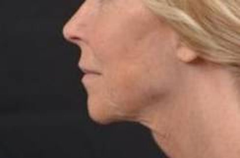 Necklift Before & After Gallery - Patient 164755 - Image 3
