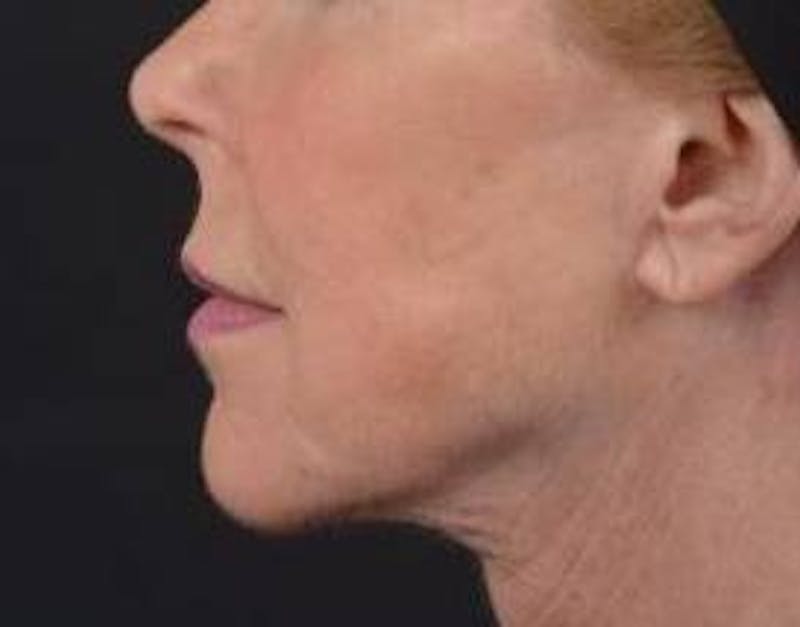 Necklift Before & After Gallery - Patient 164755 - Image 4