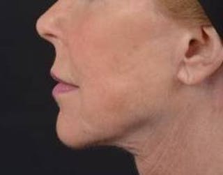 Necklift Before & After Gallery - Patient 164755 - Image 4
