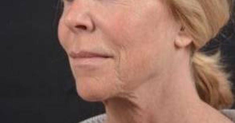 Necklift Before & After Gallery - Patient 164755 - Image 7