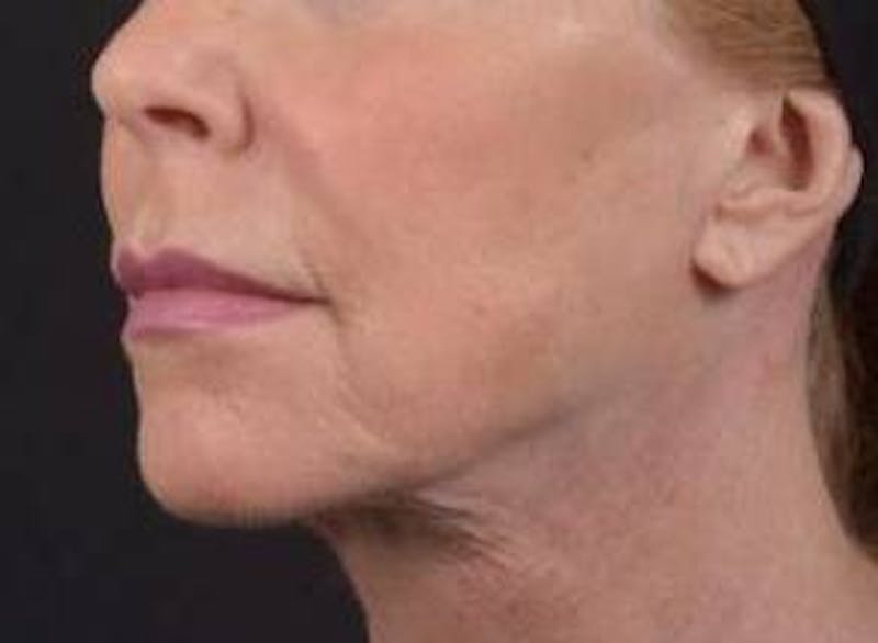Necklift Before & After Gallery - Patient 164755 - Image 8