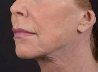 Necklift Before & After Gallery - Patient 164755 - Image 8