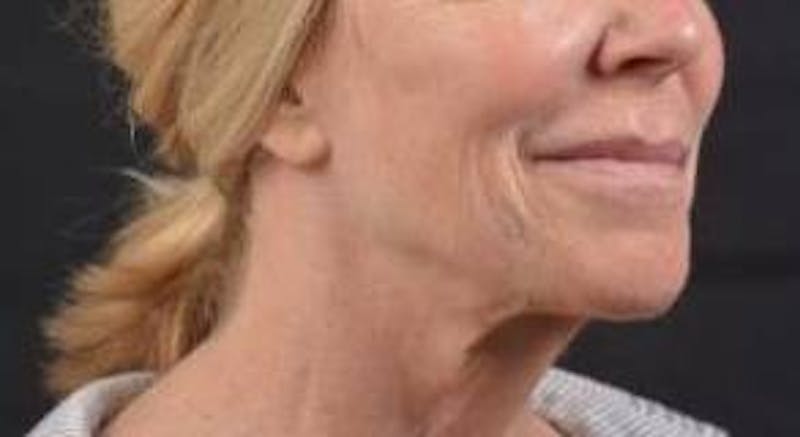 Necklift Before & After Gallery - Patient 164755 - Image 9
