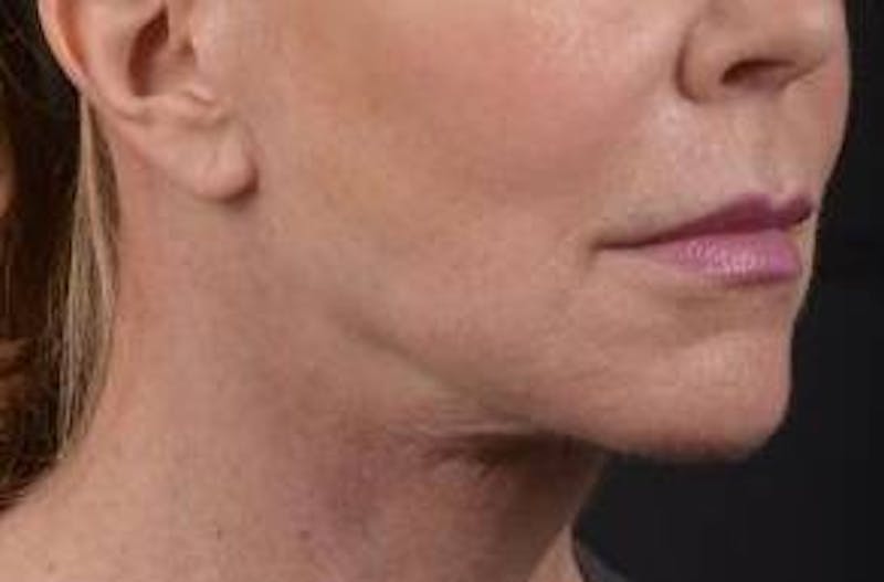 Necklift Before & After Gallery - Patient 164755 - Image 10