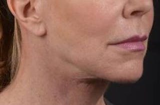 Necklift Before & After Gallery - Patient 164755 - Image 10