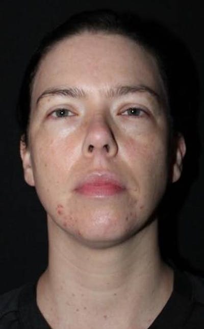 Blepharoplasty Before & After Gallery - Patient 704819 - Image 1