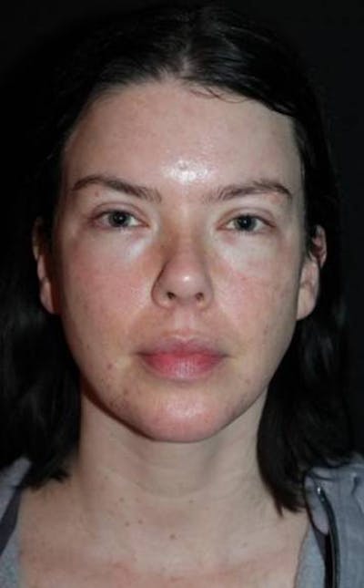 Blepharoplasty Before & After Gallery - Patient 704819 - Image 2