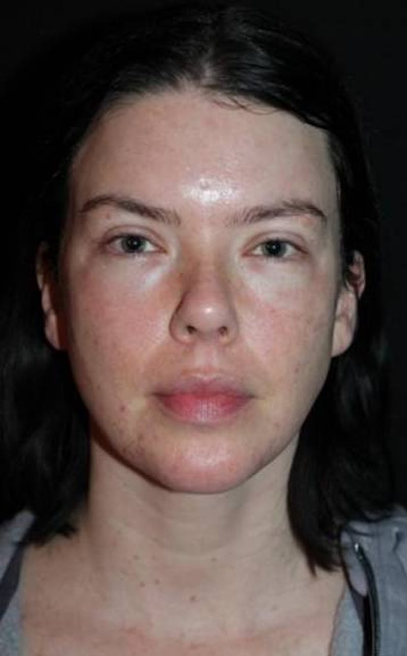 Blepharoplasty Before & After Gallery - Patient 704819 - Image 2