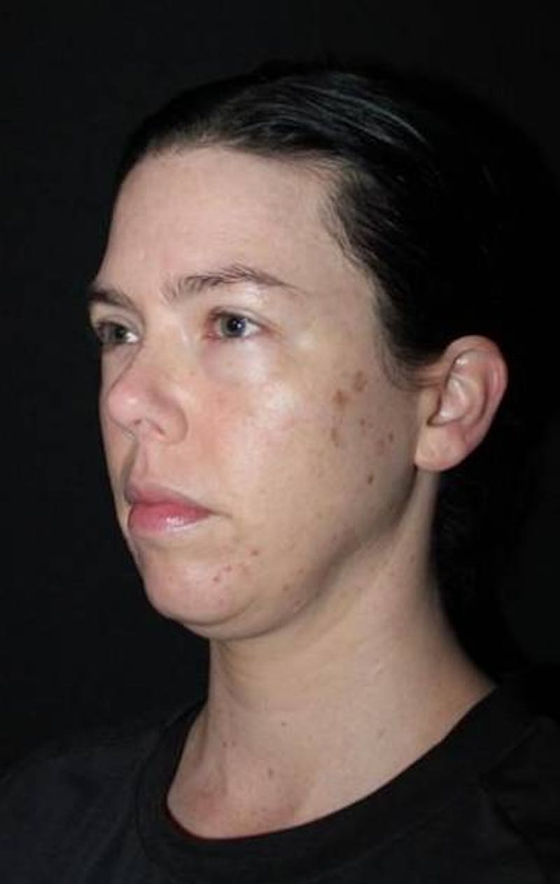Blepharoplasty Before & After Gallery - Patient 704819 - Image 3