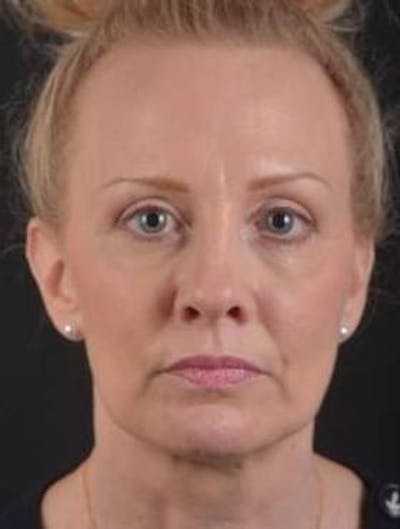 Blepharoplasty Before & After Gallery - Patient 214717 - Image 1