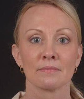 Blepharoplasty Before & After Gallery - Patient 214717 - Image 2