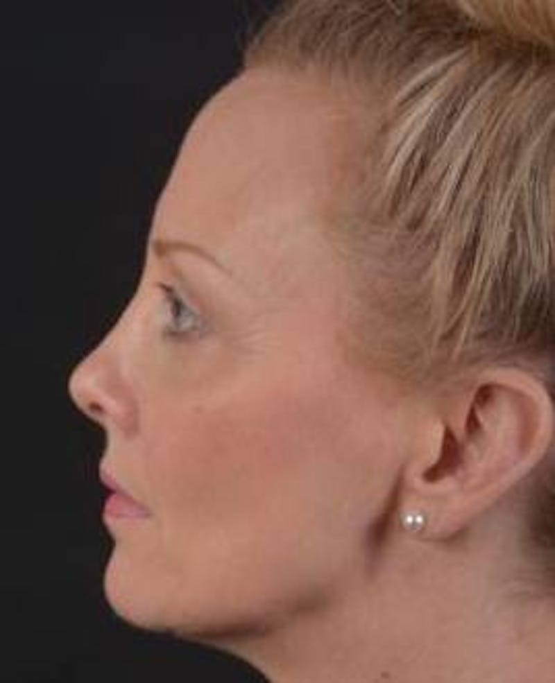 Browlift Before & After Gallery - Patient 391750 - Image 3
