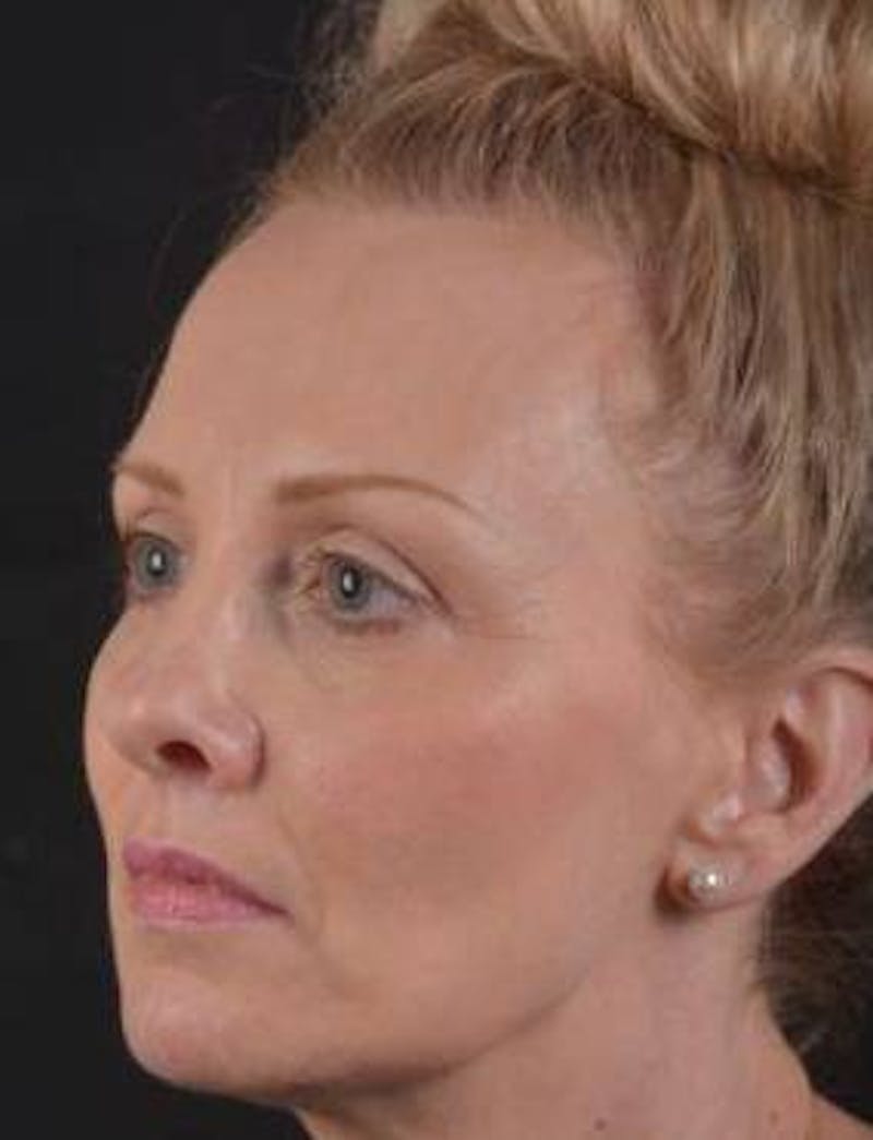 Browlift Before & After Gallery - Patient 391750 - Image 5