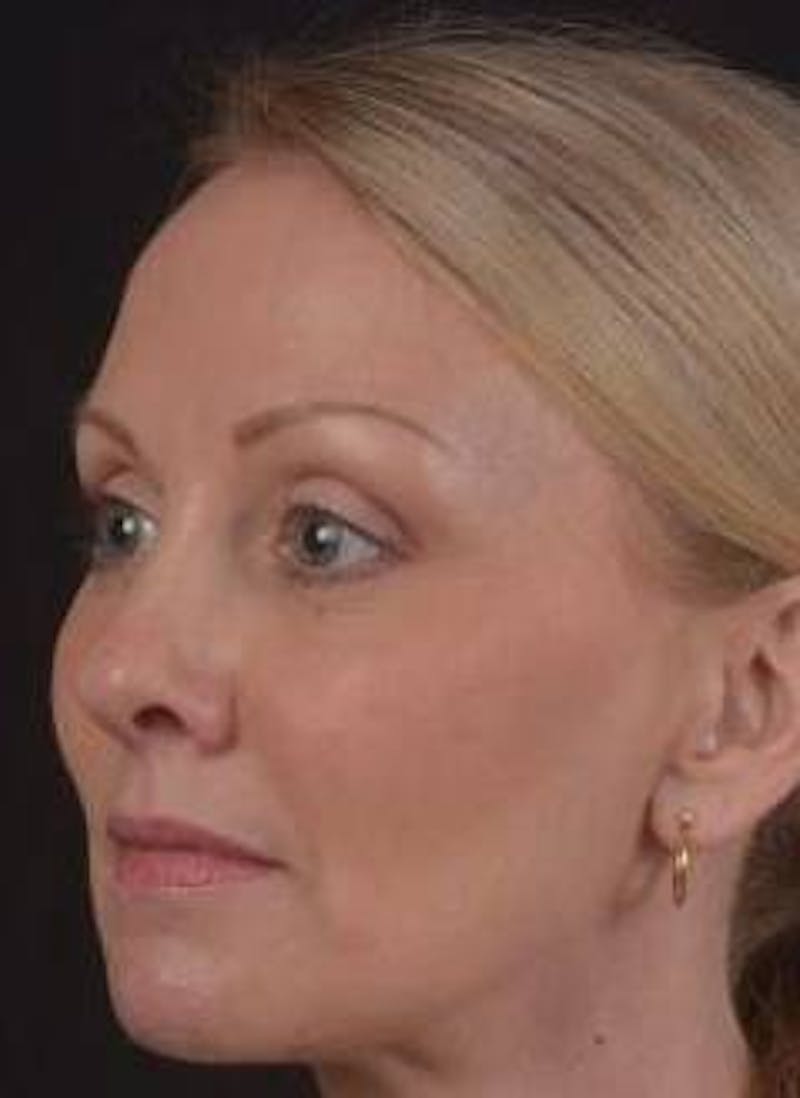 Browlift Before & After Gallery - Patient 391750 - Image 6