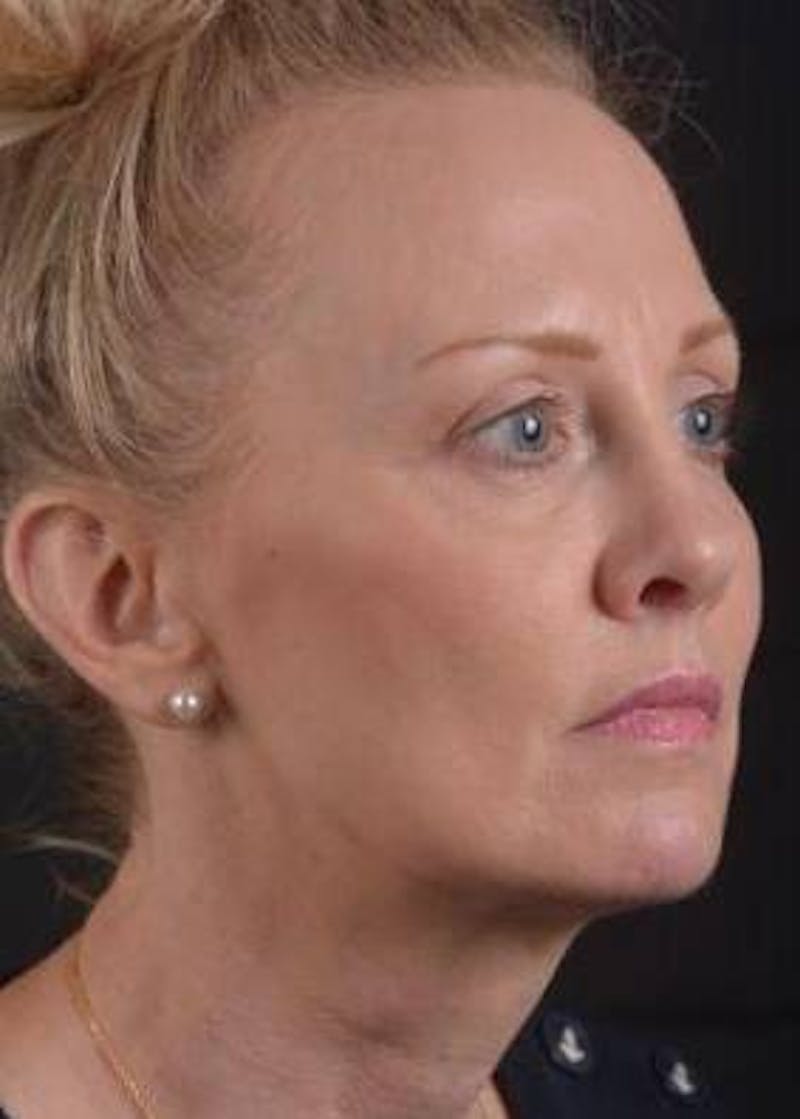 Browlift Before & After Gallery - Patient 391750 - Image 7