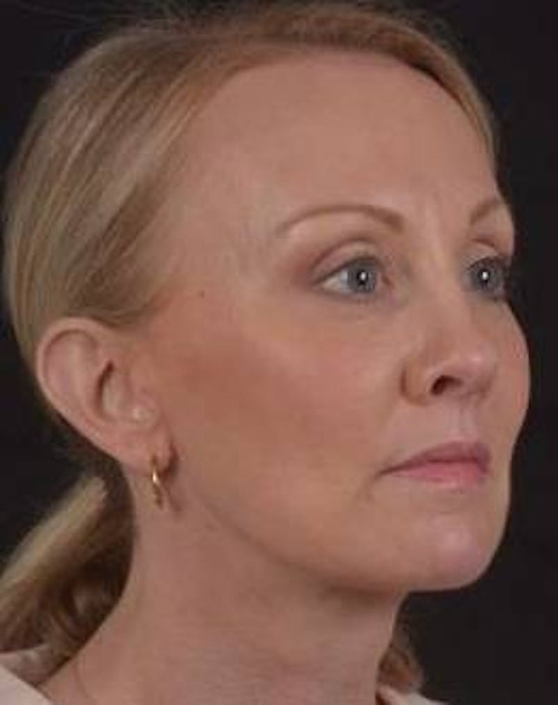 Browlift Before & After Gallery - Patient 391750 - Image 8