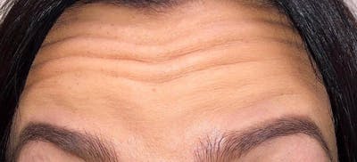 Botox Before & After Gallery - Patient 250376 - Image 1