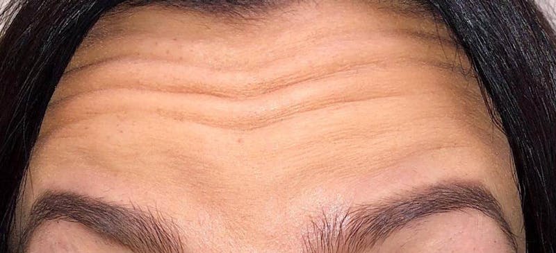 Botox Before & After Gallery - Patient 250376 - Image 1