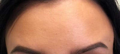 Botox Before & After Gallery - Patient 250376 - Image 2