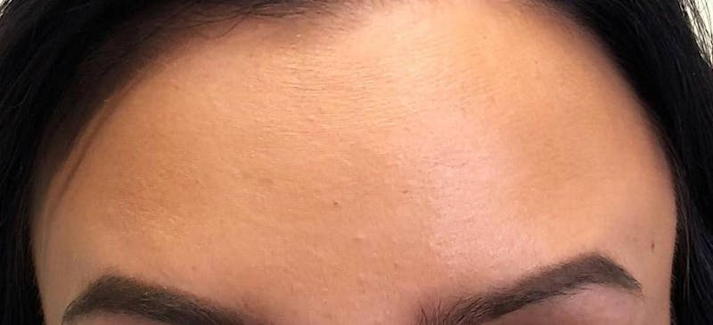 Botox Before & After Gallery - Patient 250376 - Image 2