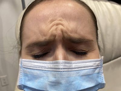 Botox Before & After Gallery - Patient 999721 - Image 1