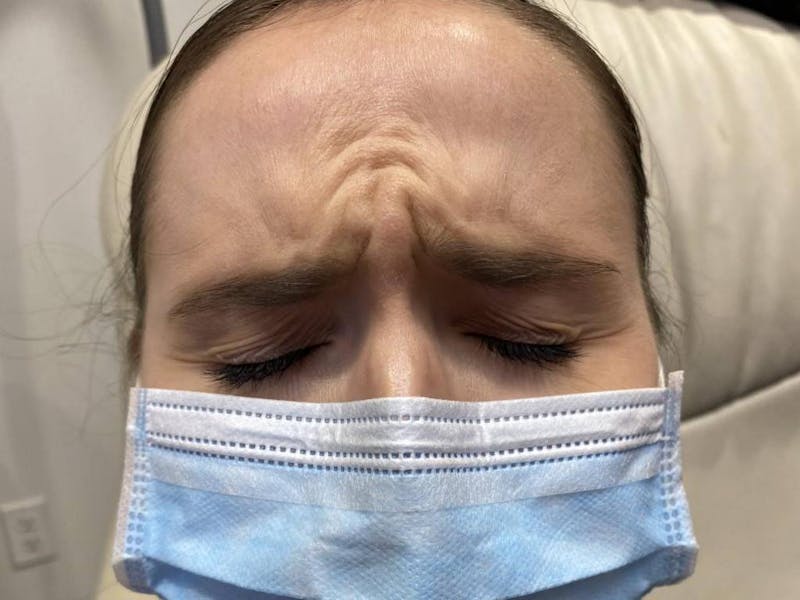 Botox Before & After Gallery - Patient 999721 - Image 1