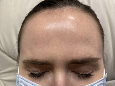 Botox Before & After Gallery - Patient 999721 - Image 2