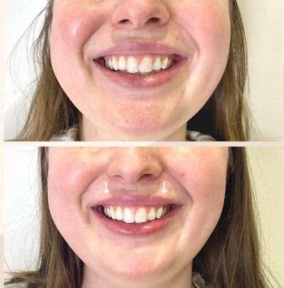 Botox Before & After Gallery - Patient 121800 - Image 1