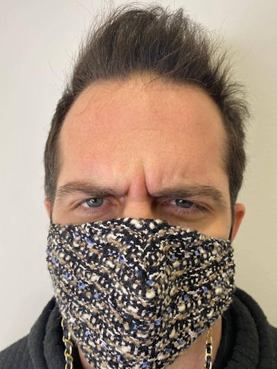 Botox Before & After Gallery - Patient 100573 - Image 1
