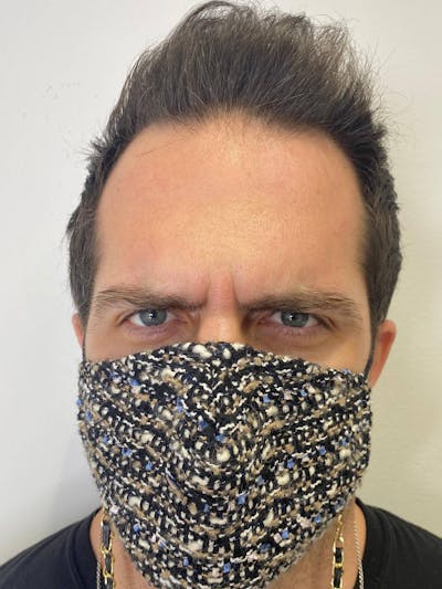 Botox Before & After Gallery - Patient 100573 - Image 2