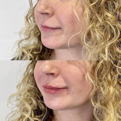 Lip Filler Before & After Gallery - Patient 931415 - Image 1