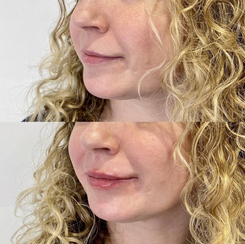 Lip Filler Before & After Gallery - Patient 931415 - Image 1