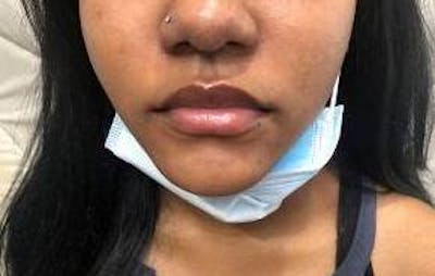 Lip Filler Before & After Gallery - Patient 260797 - Image 1