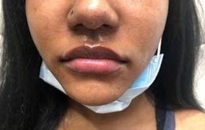 Lip Filler Before & After Gallery - Patient 260797 - Image 2