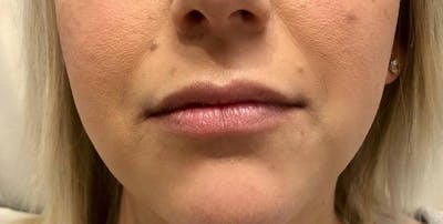Lip Filler Before & After Gallery - Patient 115598 - Image 1