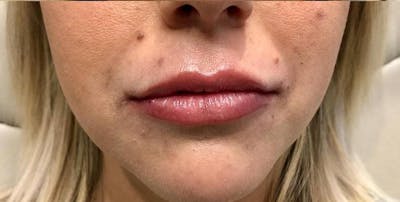 Lip Filler Before & After Gallery - Patient 115598 - Image 2