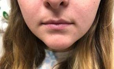 Lip Filler Before & After Gallery - Patient 261539 - Image 1