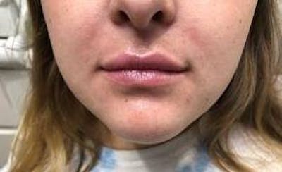 Lip Filler Before & After Gallery - Patient 261539 - Image 2