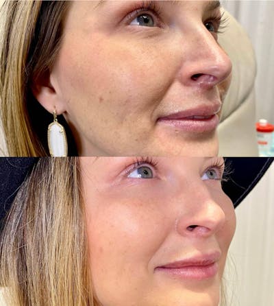 Lip Filler Before & After Gallery - Patient 272997 - Image 1