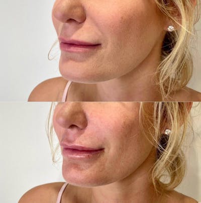 Lip Filler Before & After Gallery - Patient 290736 - Image 1