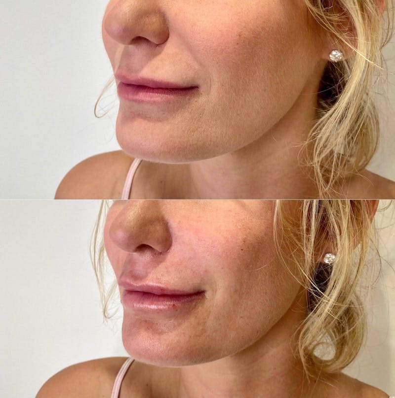 Lip Filler Before & After Gallery - Patient 290736 - Image 1