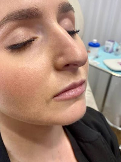 Lip Filler Before & After Gallery - Patient 417548 - Image 1