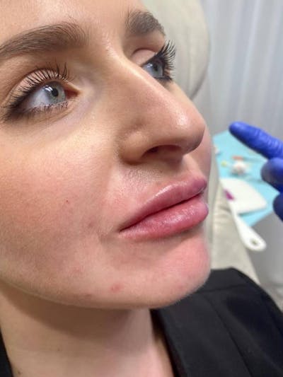 Lip Filler Before & After Gallery - Patient 417548 - Image 2