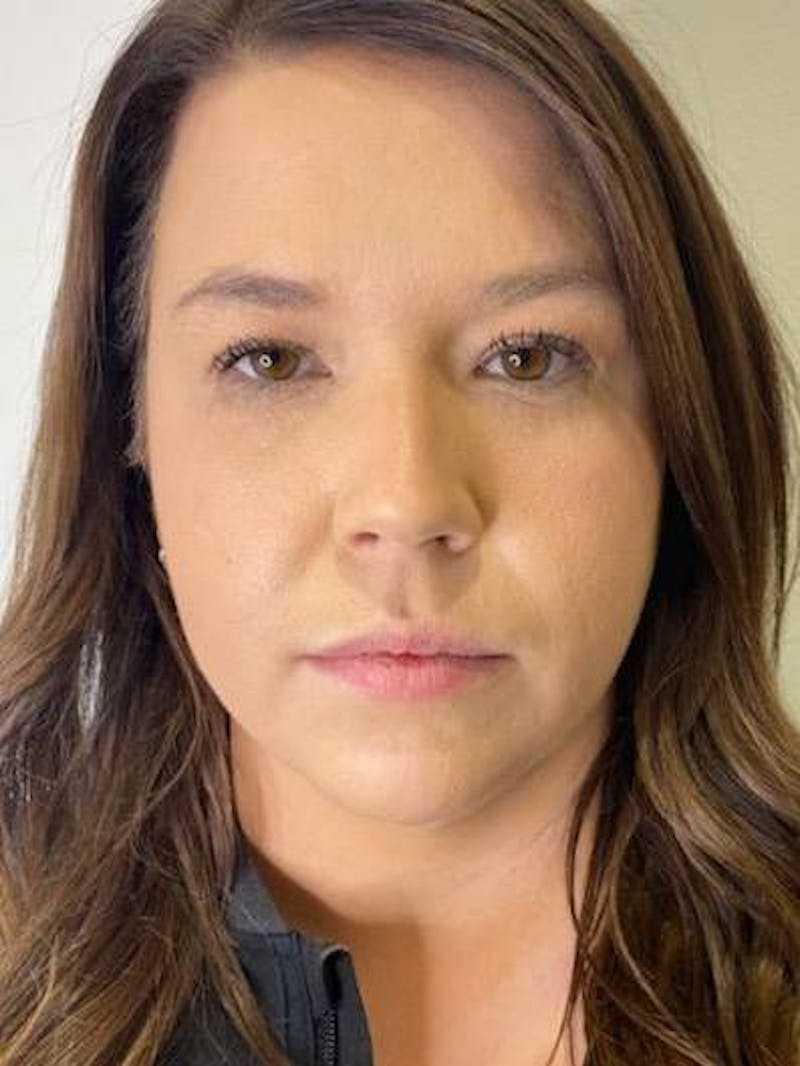 Lip Filler Before & After Gallery - Patient 187862 - Image 1