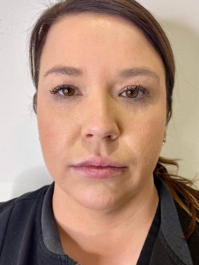 Lip Filler Before & After Gallery - Patient 187862 - Image 2
