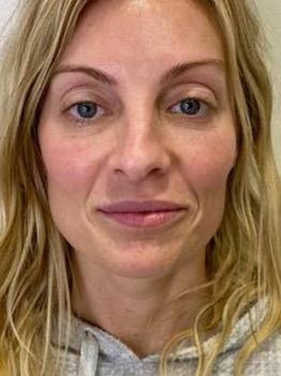 Lip Filler Before & After Gallery - Patient 419909 - Image 1