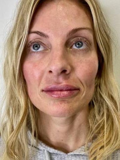 Lip Filler Before & After Gallery - Patient 419909 - Image 2