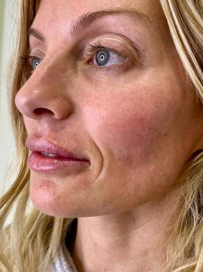 Lip Filler Before & After Gallery - Patient 419909 - Image 4